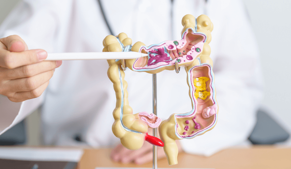 Dieta per diverticolosi